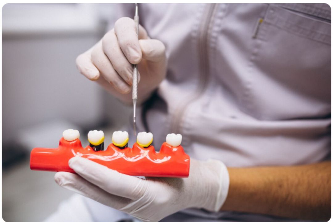 all teeth implant cost in india 